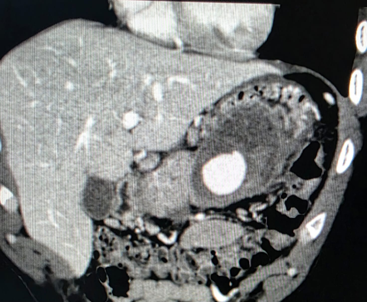 Embolization of splenic artery