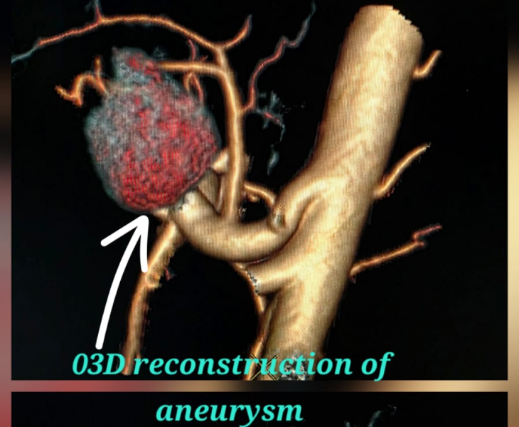 Embolization of splenic artery