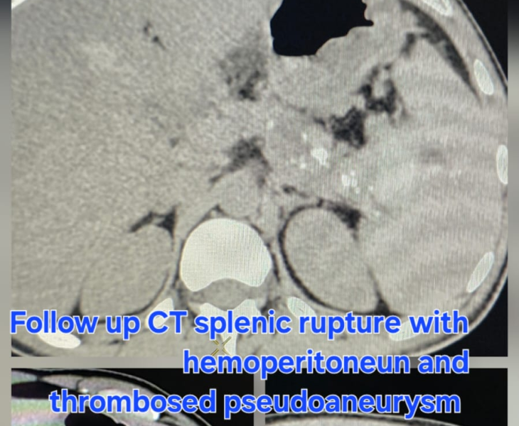 Super selective coil embolization