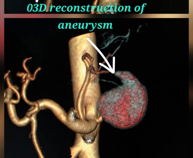 Embolization of splenic artery
