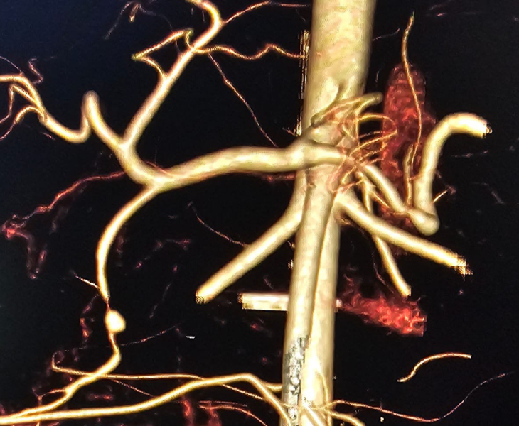 Super selective coil embolization