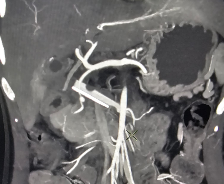 Post embolization angiography