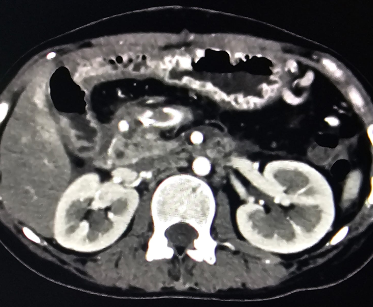 Post embolization angiography