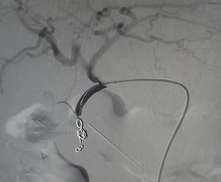 Post embolization angiography