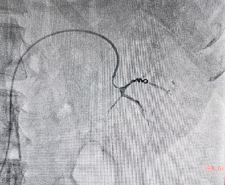 Post embolization angiography