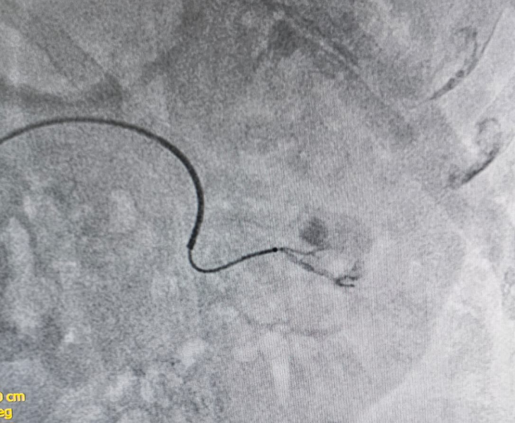 Post embolization angiography