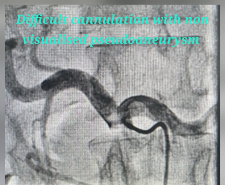 Embolization of splenic artery