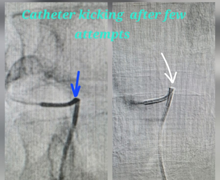 Embolization of splenic artery