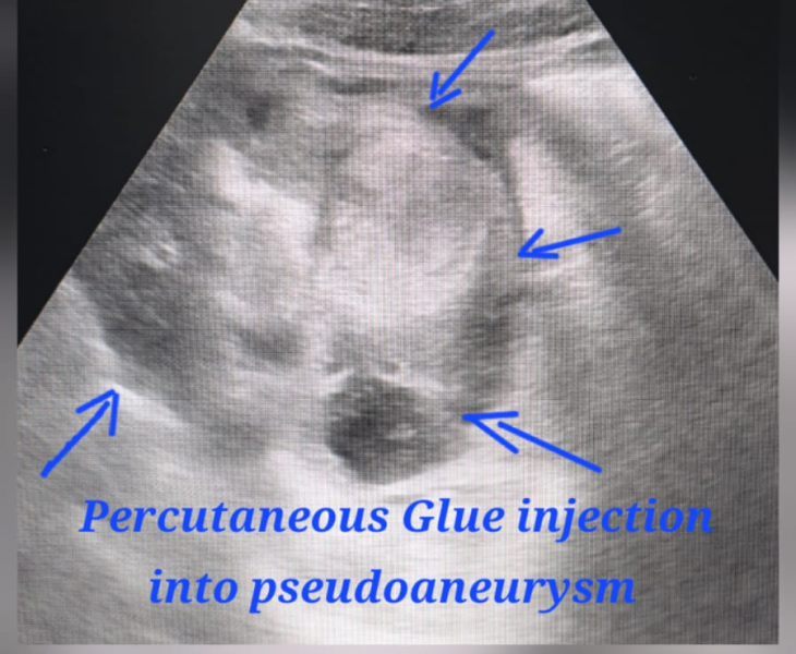 Embolization of splenic artery