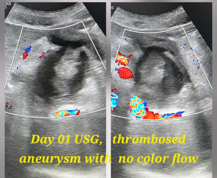Embolization of splenic artery