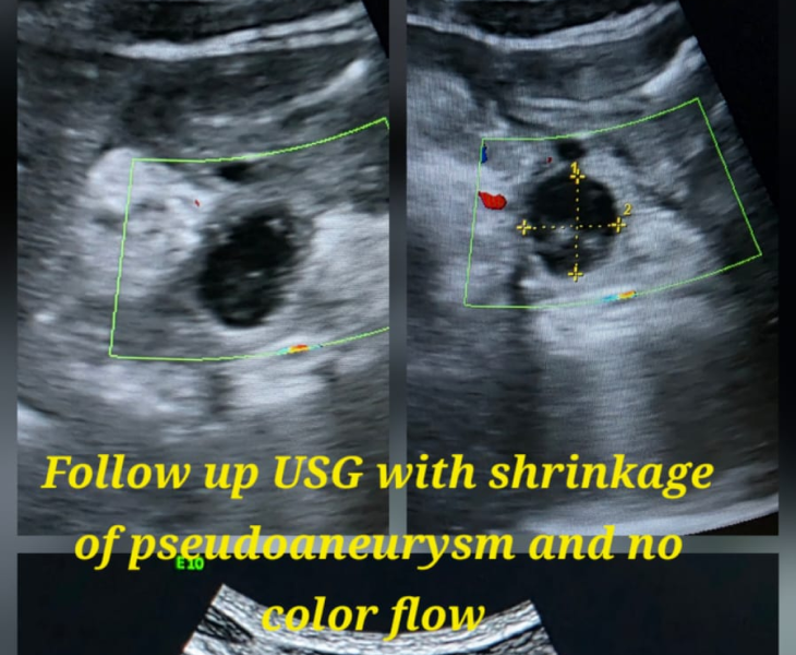 Embolization of splenic artery