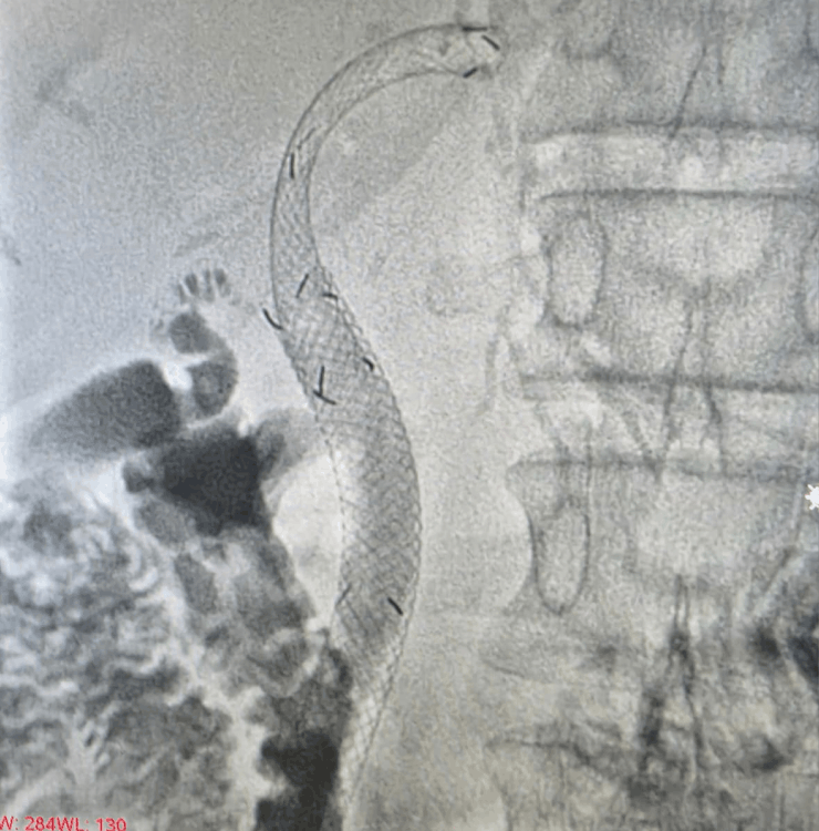 Biliary stent placement for jaundice - image 1