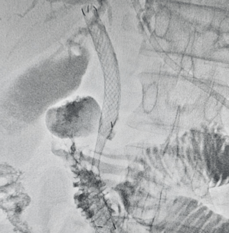 Biliary stent placement for jaundice - image 2