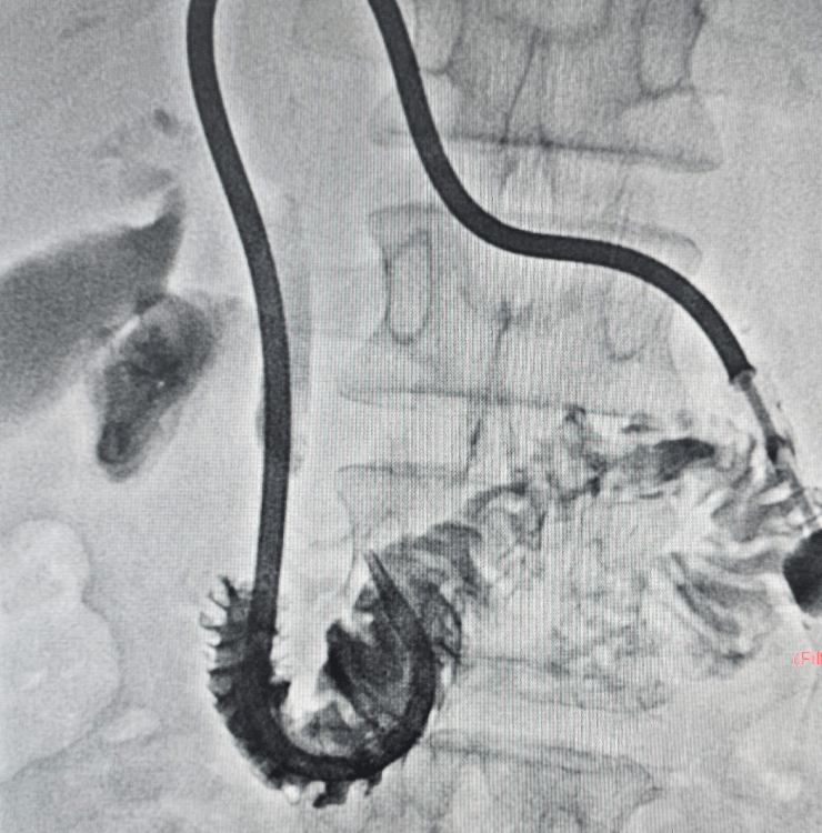 Catheter access for percutaneous biliary drainage