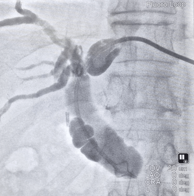 PTBD and Biliary Stenting