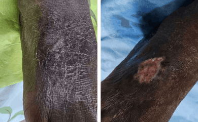 Varicose vein treatment