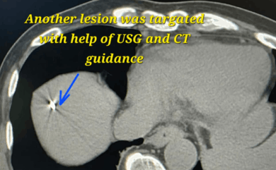 Interventional cancer treatment