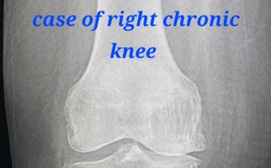 Treatment of Chronic Knee Pain