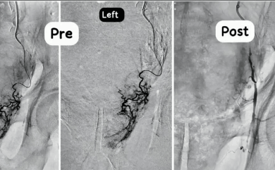 Prostatic Artery Embolization