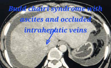 TIPS & DIPS Procedures for Liver Disease