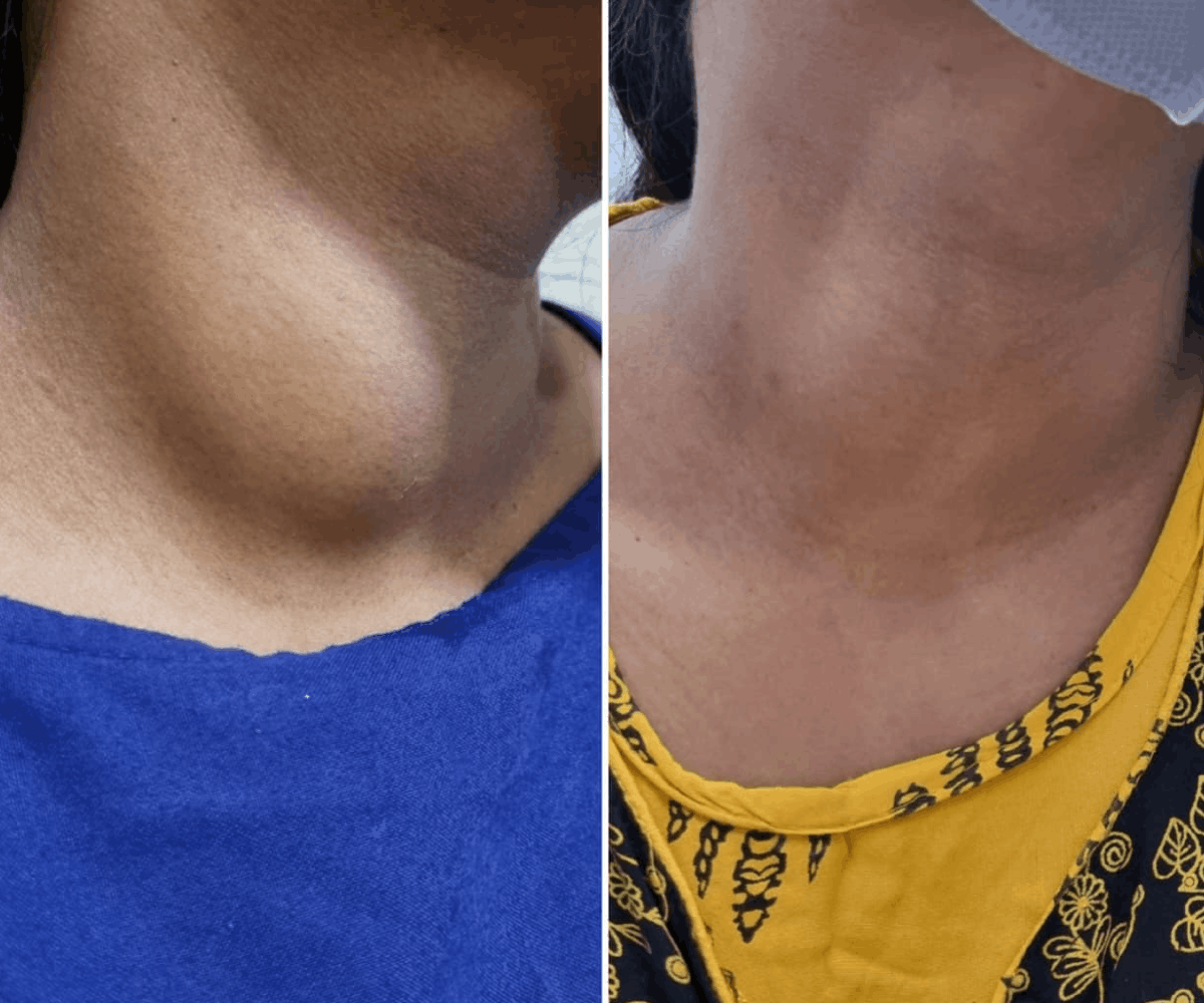 Microwave ablation of thyroid nodules