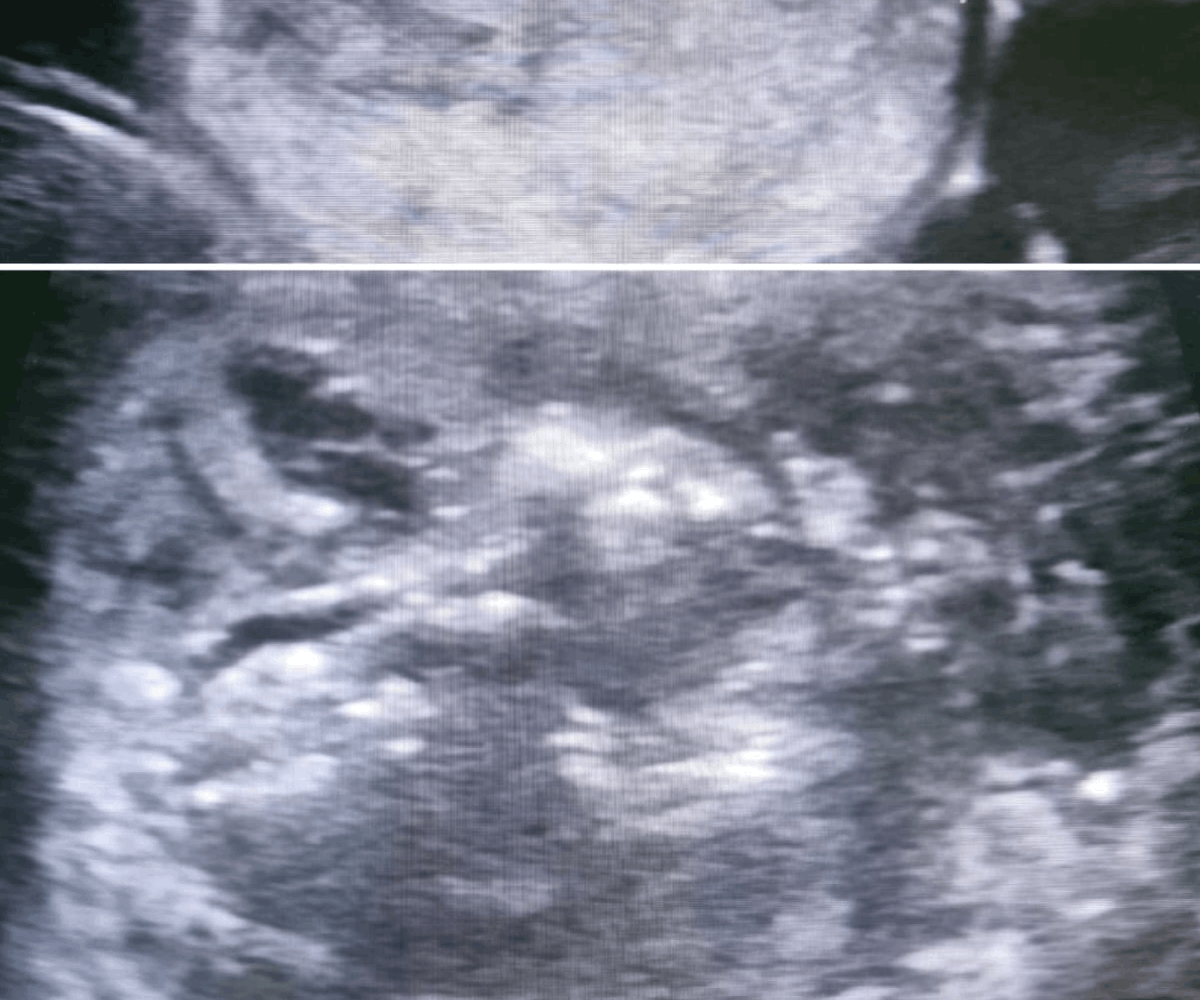 Microwave ablation of thyroid nodule - image 2