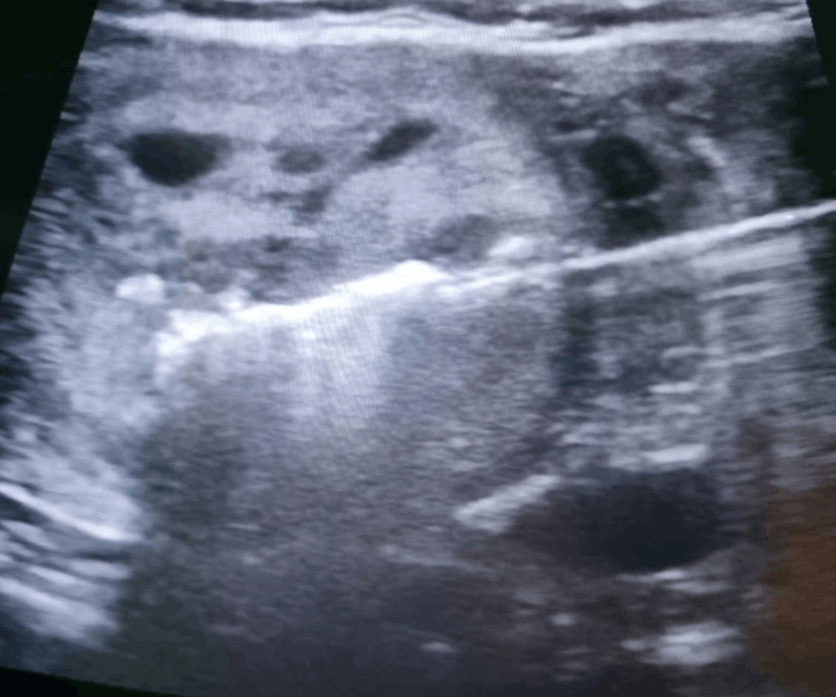 Microwave ablation of thyroid nodule - image 2