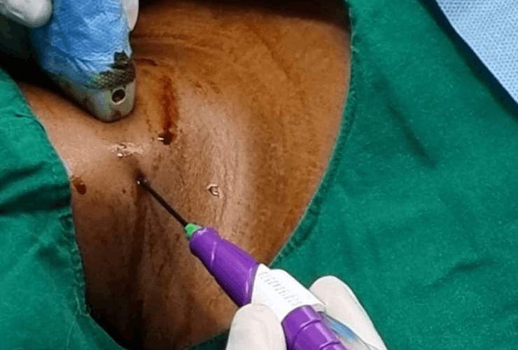 Thyroid treatment before and after results