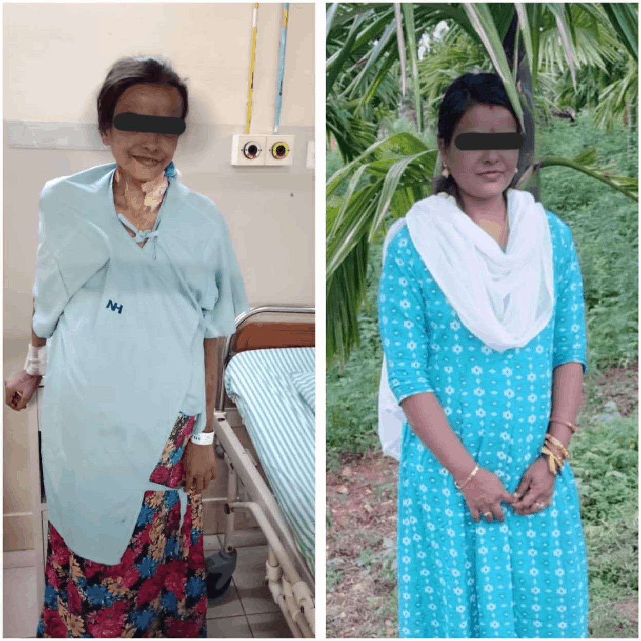 Before and after TIPS/DIPS procedure - patient outcome