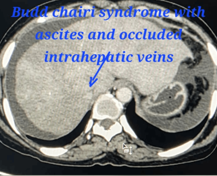 IVC and portogram for stent placement