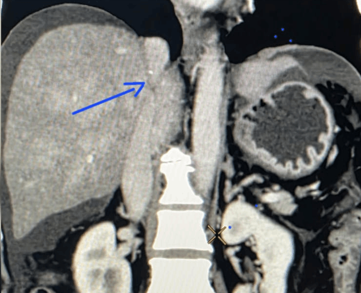 Placement of DIPS stent with good flow across the shunt