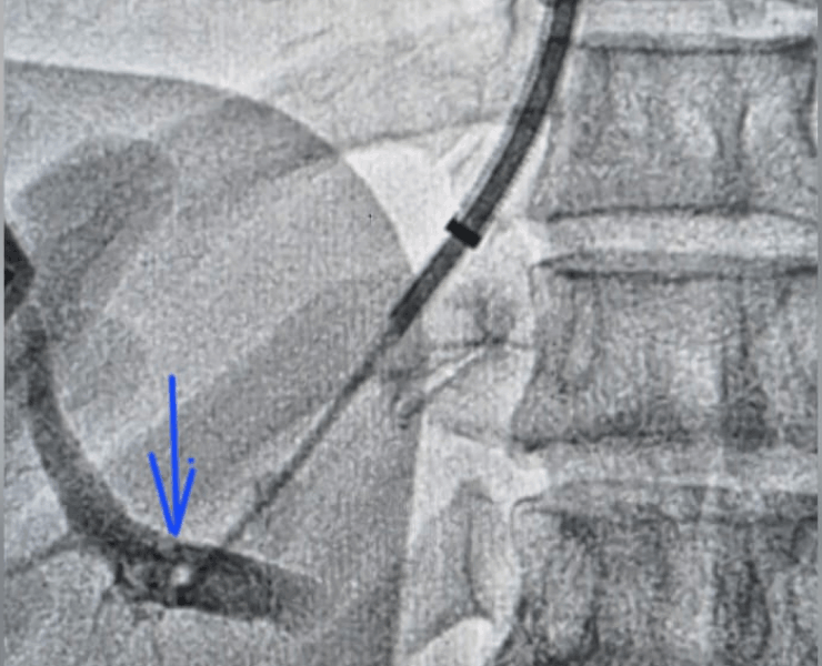 IVC and portogram for stent placement