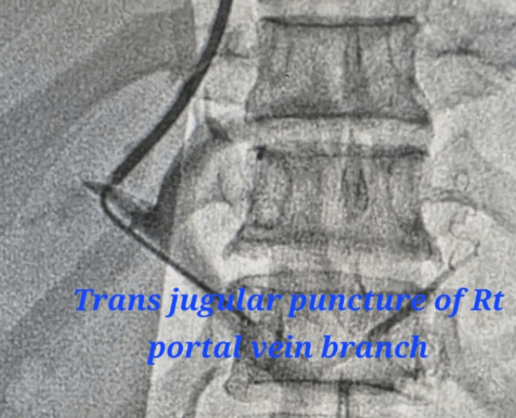Placement of DIPS stent with good flow across the shunt