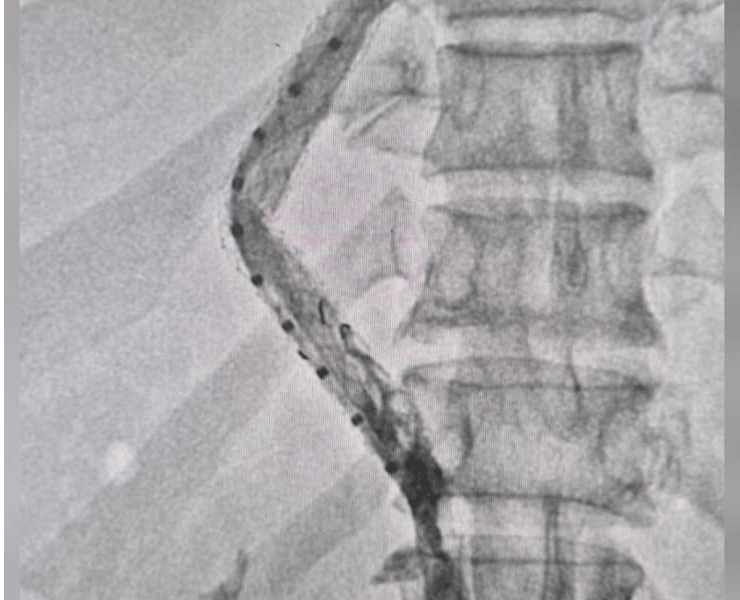 IVC and portogram for stent placement