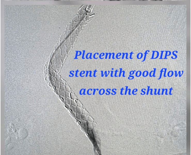 Placement of DIPS stent with good flow across the shunt