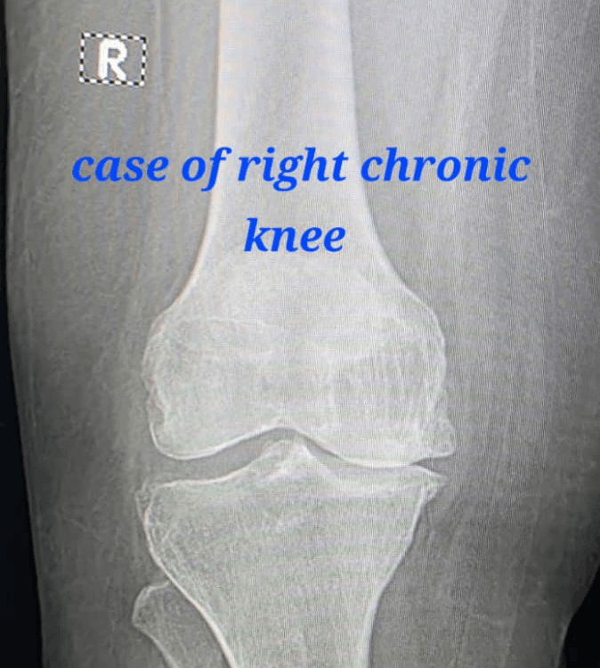 Treatment of Chronic Knee Pain