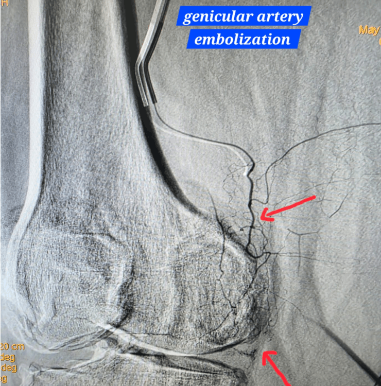 Genicular artery embolization angiogram