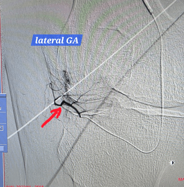Lateral genicular artery angiogram
