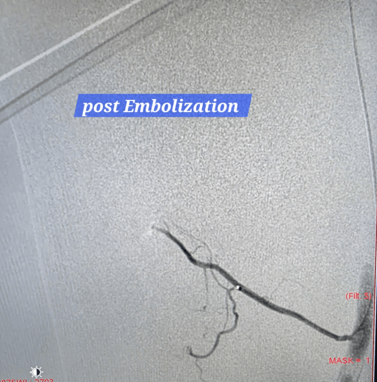Post embolization follow-up image