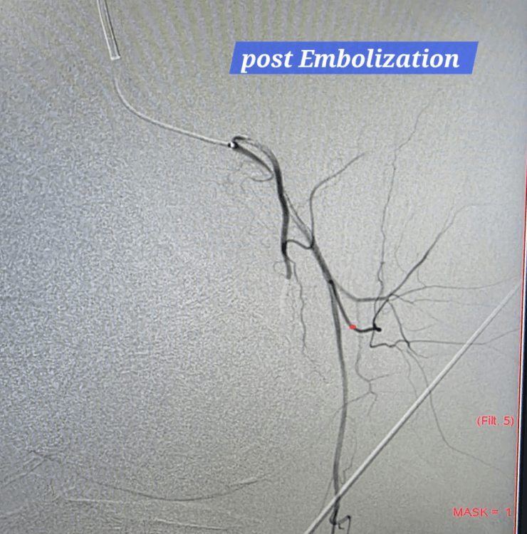 Lateral genicular artery angiogram