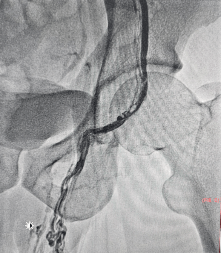 Varicocele Treatment for Male Infertility
