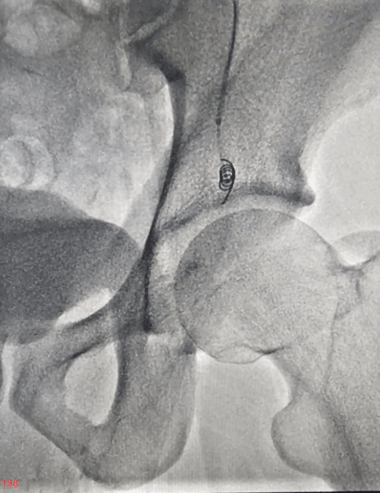 Coils placed during varicocele embolization - step 1
