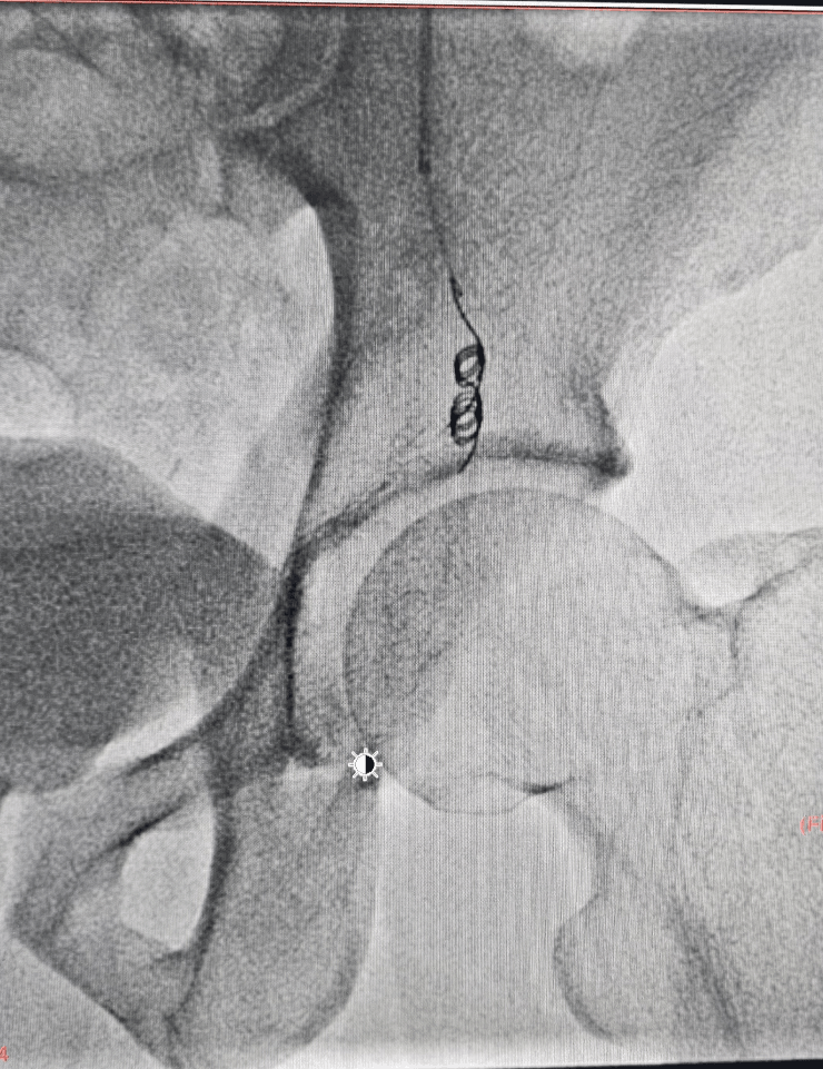 Coils placed during varicocele embolization - step 2