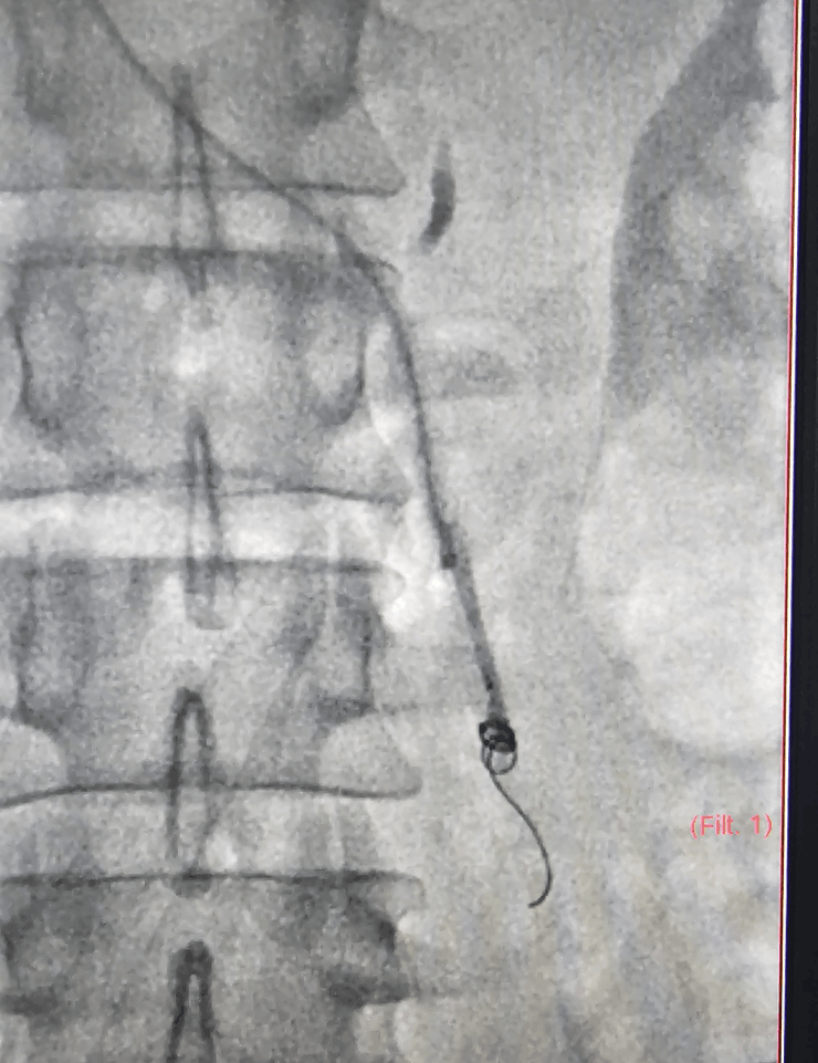 Final appearance after varicocele embolization