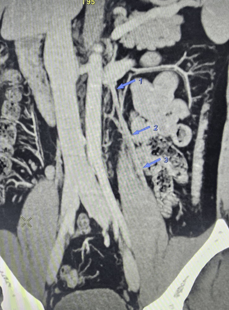 Imaging evaluation for varicocele treatment