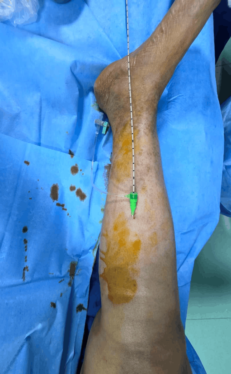 Microwave ablation for varicose veins