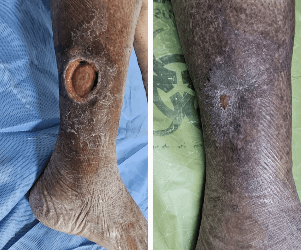 Venous ulcer before and after treatment