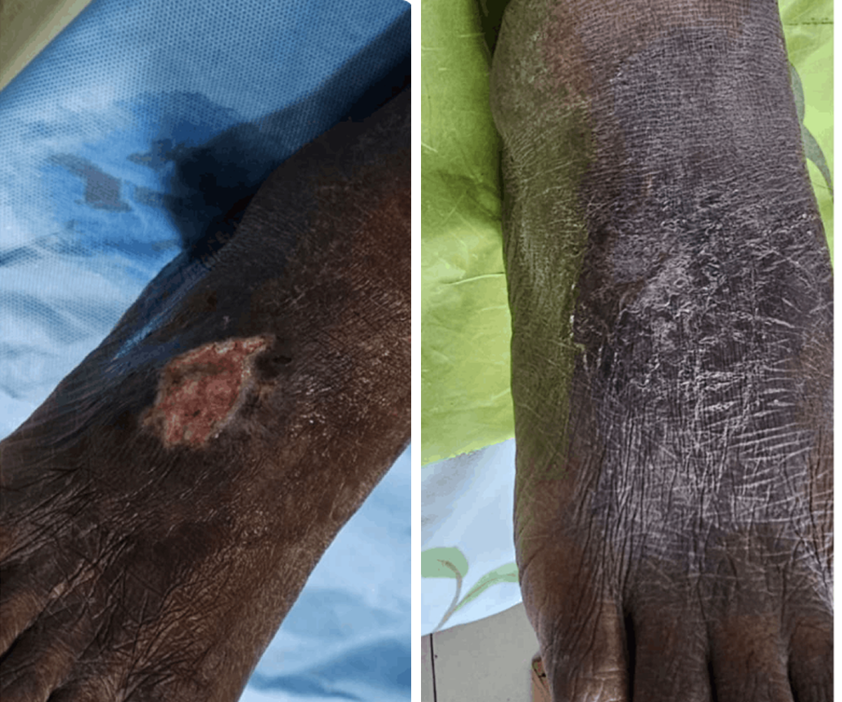 Healing progress after varicose vein treatment