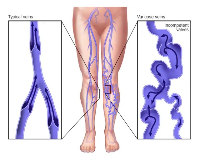 Varicose vein treatment