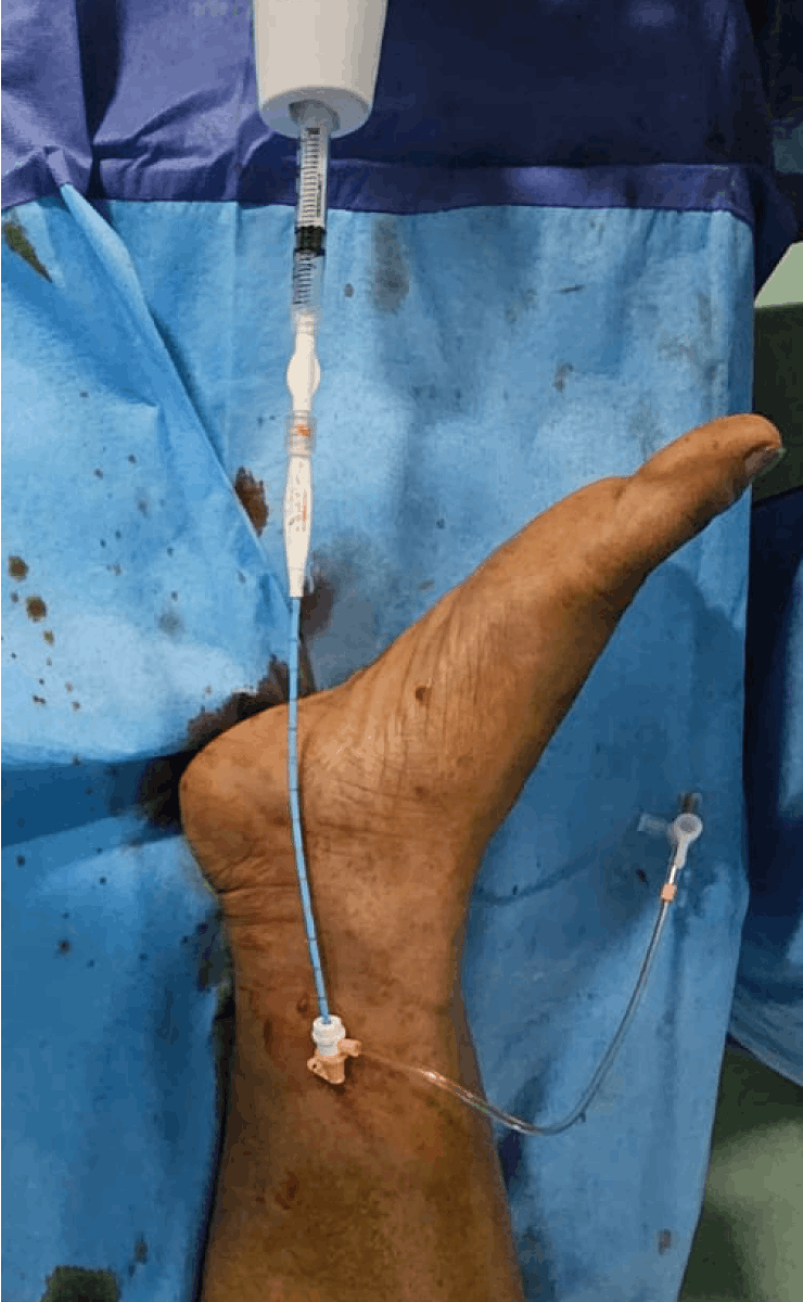 VenaSeal glue embolization for varicose veins